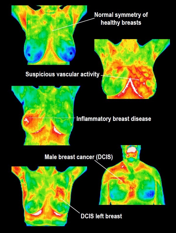 inflammatory breast cancer ultrasound